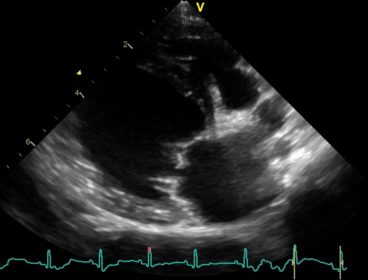 Echo image of dilated heart and thickened mitral valve