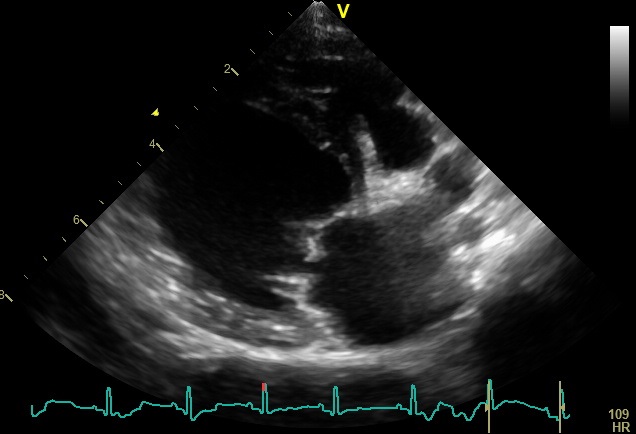 Echo image of dilated heart and thickened mitral valve